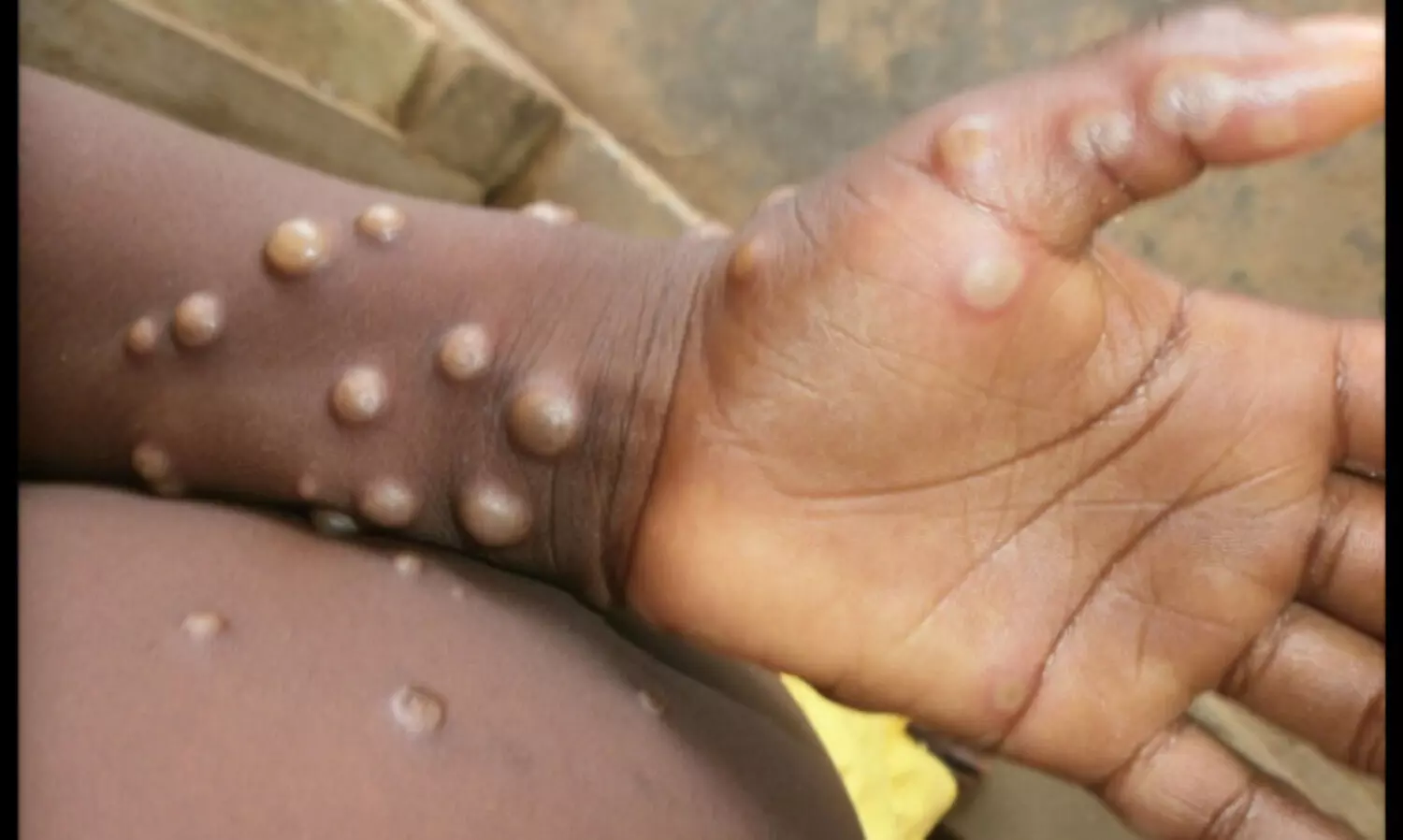 Strengthen surveillance, public health measures for monkeypox: WHO