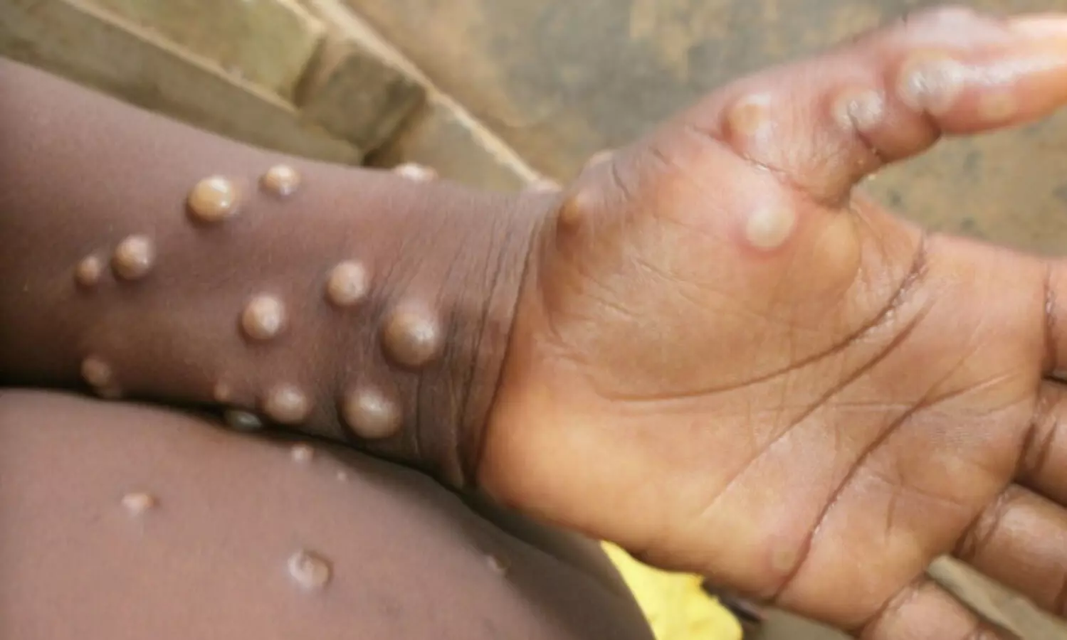 Monkeypox: What is it and how can we prevent the spread?