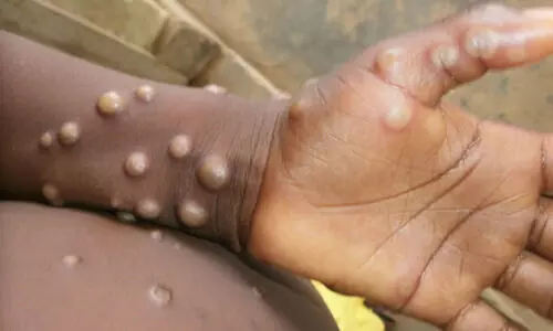 Monkeypox: What is it and how can we prevent the spread?