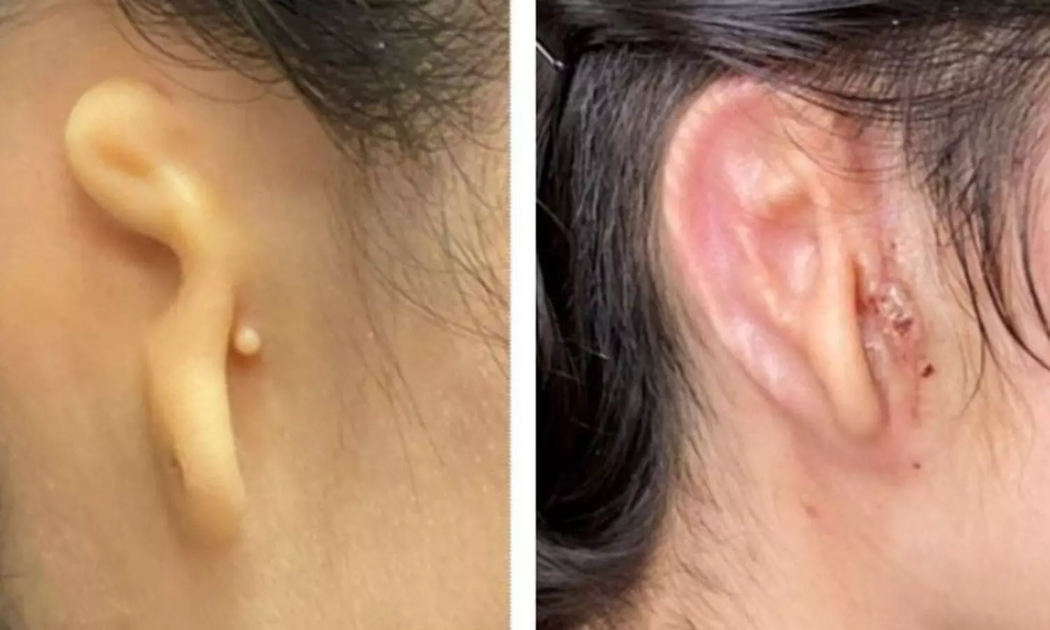 Woman implanted with 3D-printed ear made from her own cells