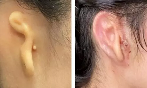 Woman implanted with 3D-printed ear made from her own cells