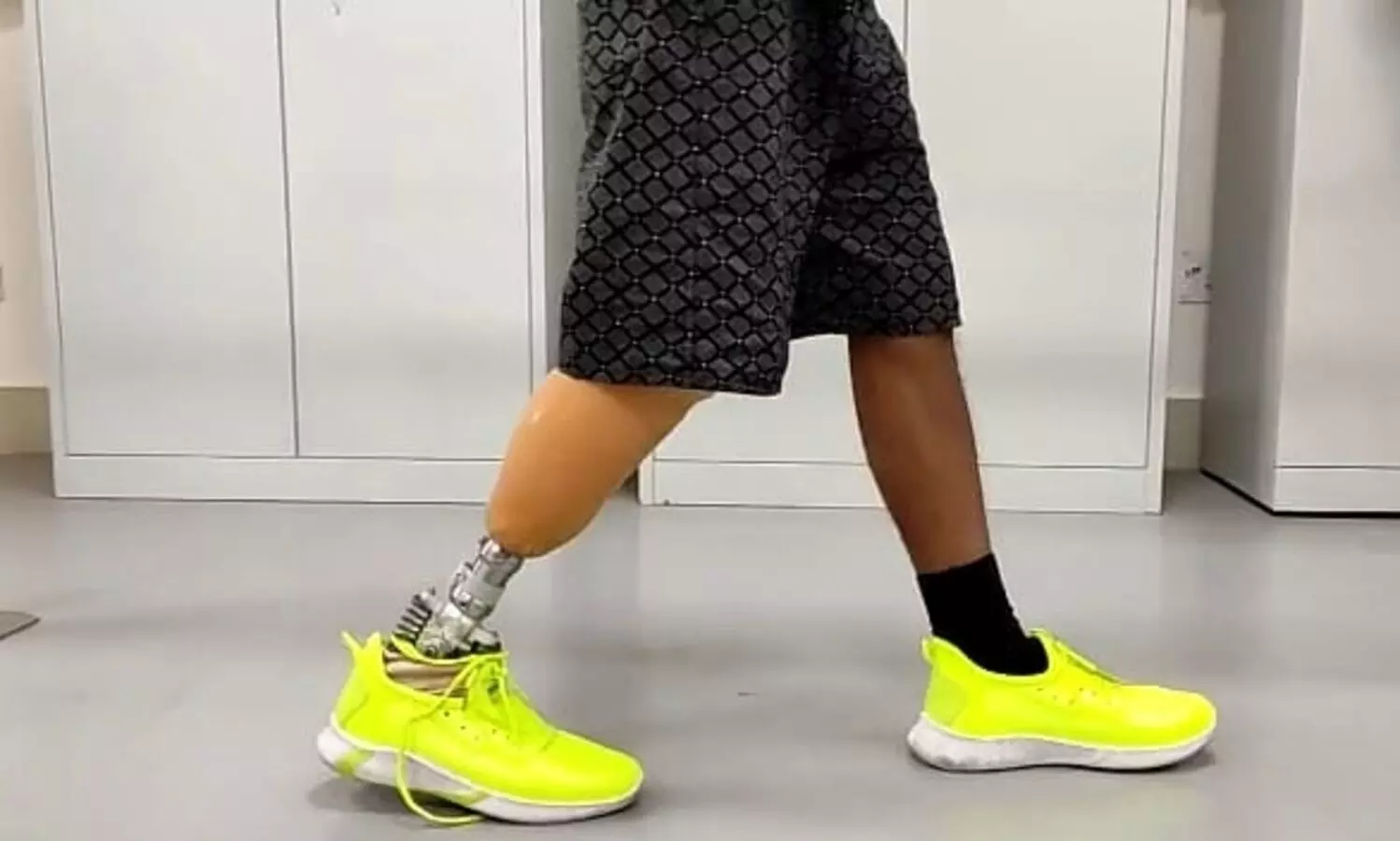 IIT Guwahati develops prosthetic leg for Indian conditions