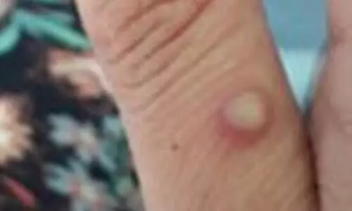 World Health Network declares monkeypox outbreak a pandemic