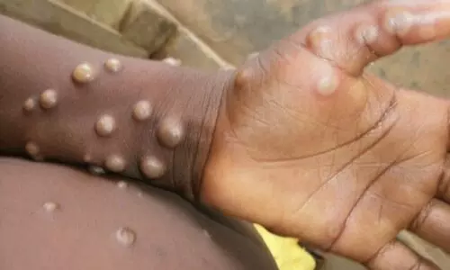 First case of monkeypox in India reported from Kerala