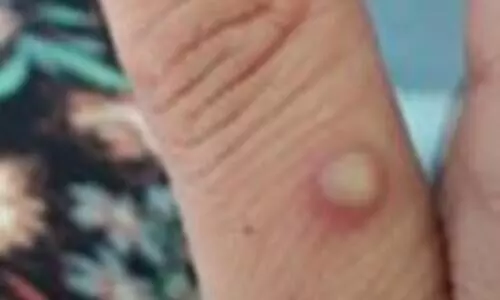 Monkeypox strain in India different from Europe: ICMR-NIV study