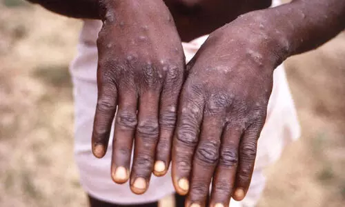 Third case of monkeypox reported from Kerala