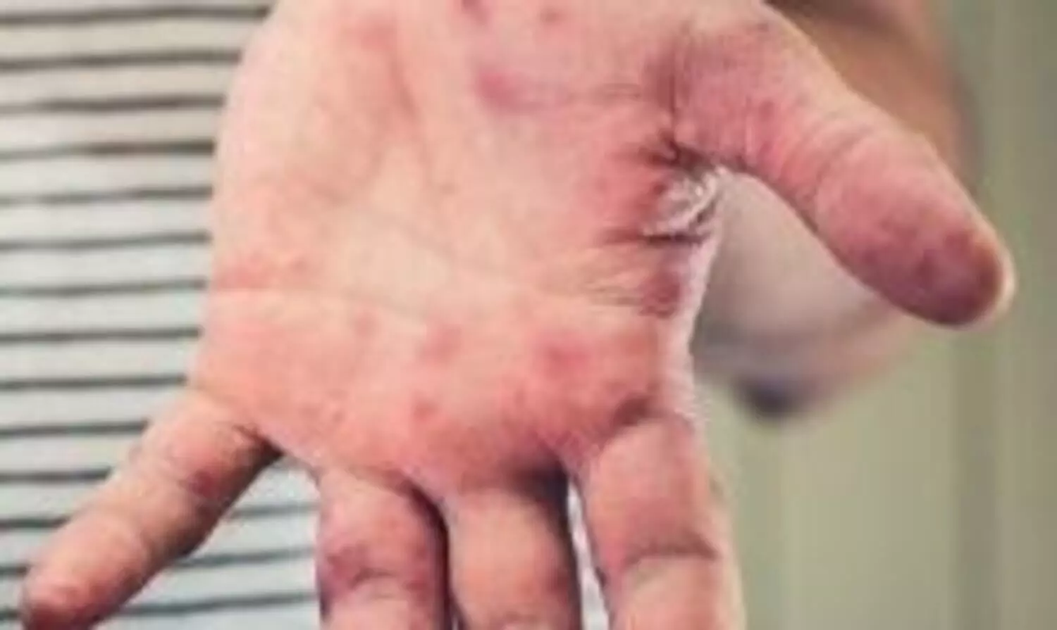 UP issues advisory on tomato flu