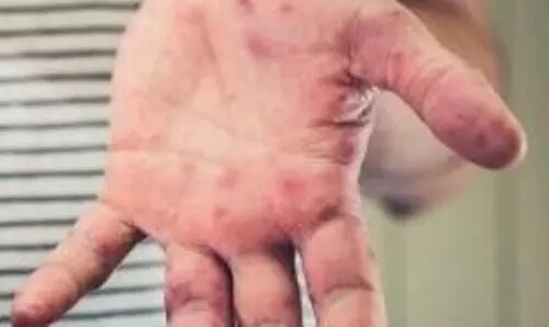 UP issues advisory on tomato flu