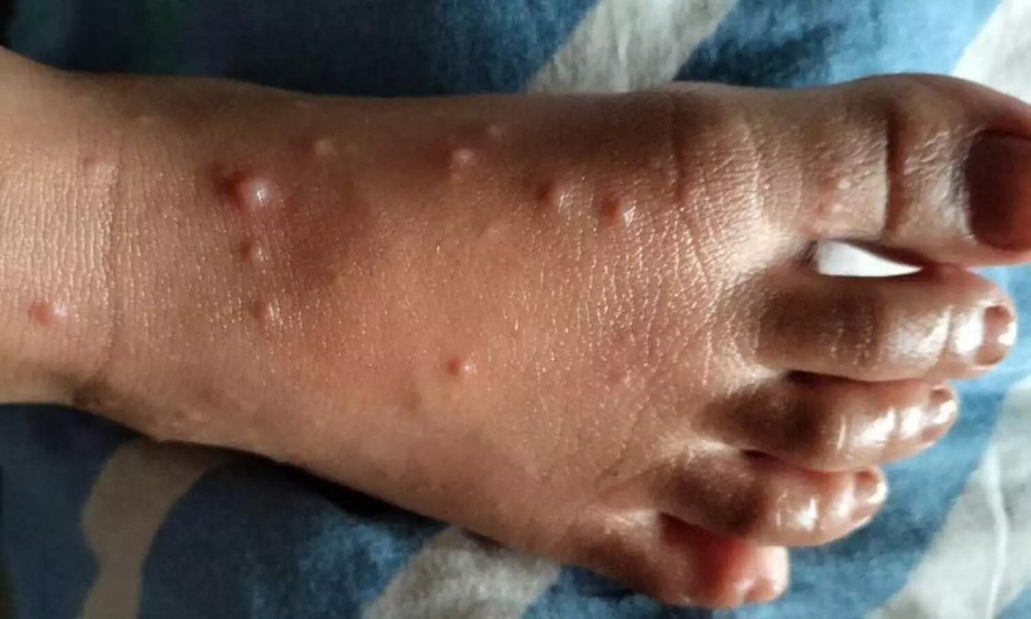 Hand-Foot-Mouth Disease caused by Coxsackievirus A16 increases in Assam