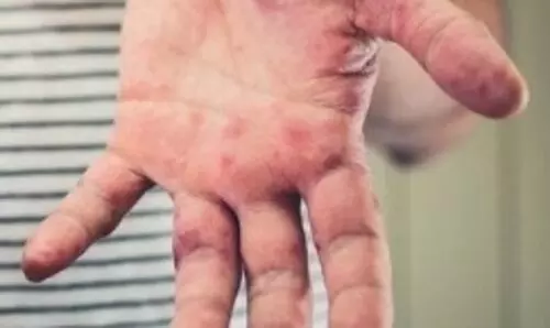 New Tomato flu variant creates health scare among kids in several states