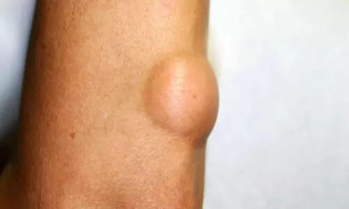 Dont ignore painless lumps in body: experts