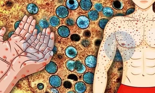 Mizoram sets up Monkeypox preparedness committee, issues rumour warning to public