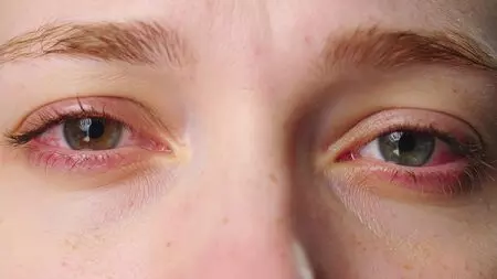 Delhi doctors see 50% rise in eye problems as toxic smog persists