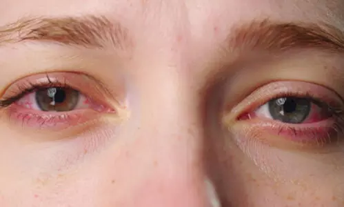 Delhi doctors see 50% rise in eye problems as toxic smog persists