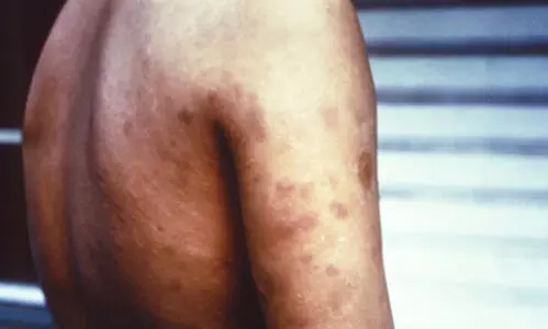 Maharashtra govt to launch statewide anti-leprosy drive from November 17