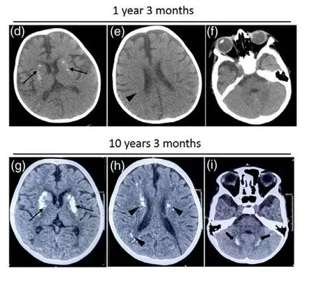 Indian researchers find rare mutation causing recurrent neuro issues in children
