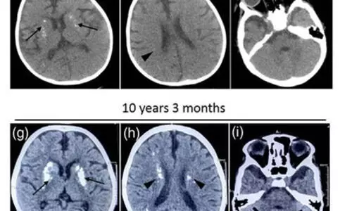 Indian researchers find rare mutation causing recurrent neuro issues in children