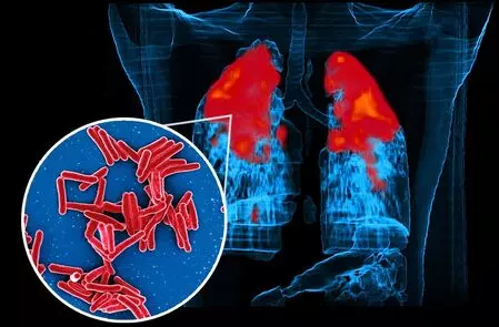 IIT Bombay study reveals how TB bacteria shield themselves from antibiotics