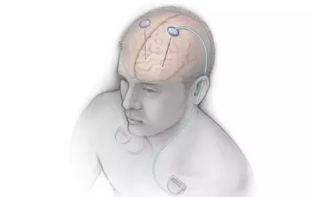 AIIMS hosts India’s first DBS workshop for Parkinson’s and movement disorders AIIMS hosts India’s first DBS workshop for Parkinson’s and movement disorders