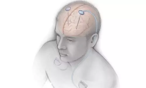 AIIMS hosts India’s first DBS workshop for Parkinson’s and movement disorders