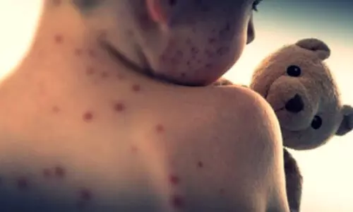 Outbreak intensifies as measles cases rise in Bangladesh