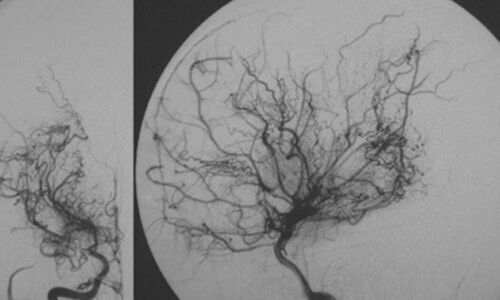 MIND MATTERS - Depression and moyamoya disease